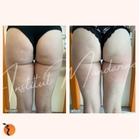 traitement-minceur-15