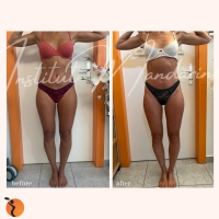 traitement-minceur-17