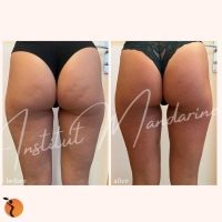 traitement-minceur-18